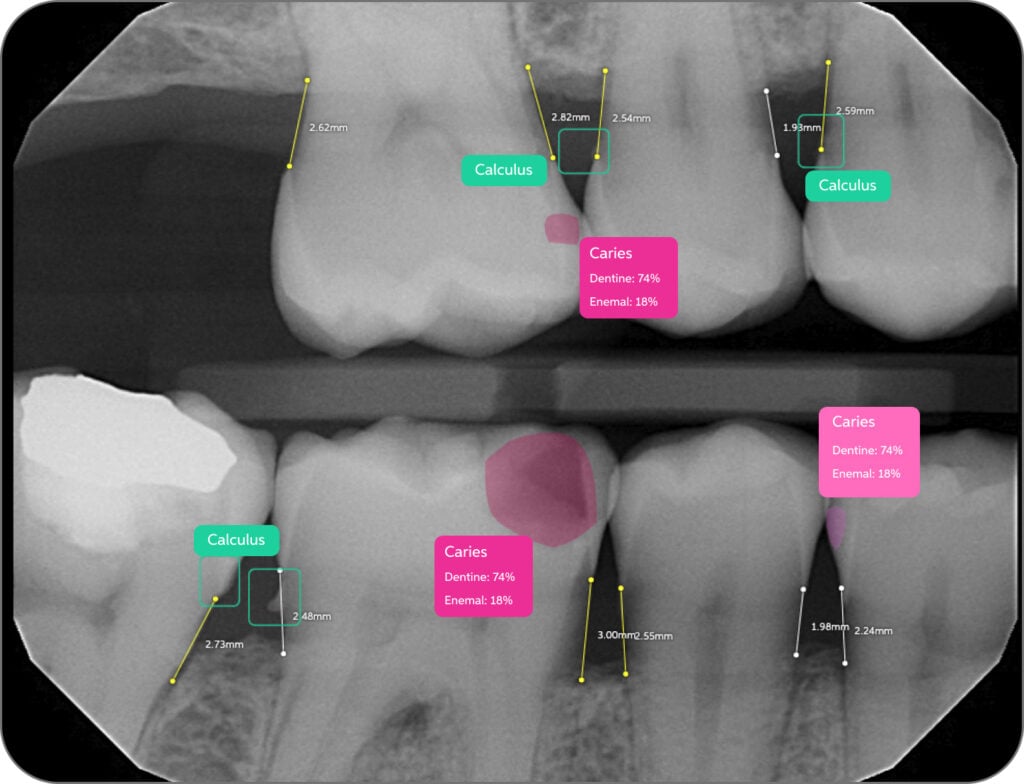 Pearl AI dental diagnostics flagging caries and calculus on a bitewing radiograph for DSO clinicians